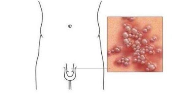 早期生殖疱疹的症状和治疗，长水疱伴随瘙痒疼痛(附男女图片)