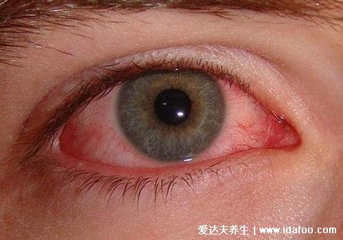 川崎病眼睛红症状图片，红双眼不痒可持续14天(有其他身体症状)
