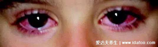 川崎病眼睛红症状图片，红双眼不痒可持续14天(有其他身体症状)