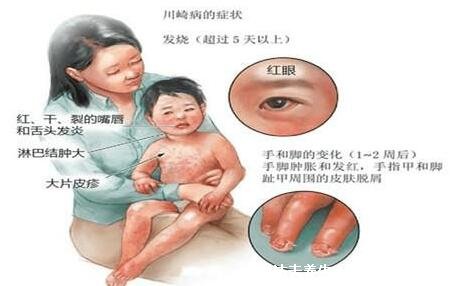 川崎病身上红疹图片，形状多且瘙痒无疱疹结痂(眼睛发红等症状)