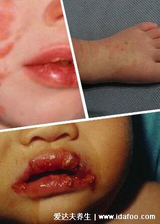 川崎病身上红疹图片，形状多且瘙痒无疱疹结痂(眼睛发红等症状)