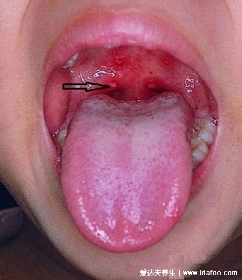 小儿手足口病最早期图片，先在嘴巴发现米粒大疱疹(有感冒症状)