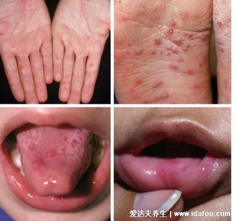 小儿手足口病最早期图片，先在嘴巴发现米粒大疱疹(有感冒症状)
