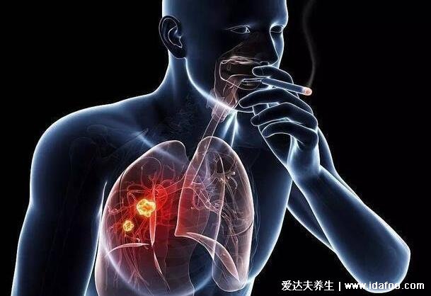 肺癌的早期症状和前兆，警惕早期八个信号(咳嗽/消瘦/呼吸不畅)