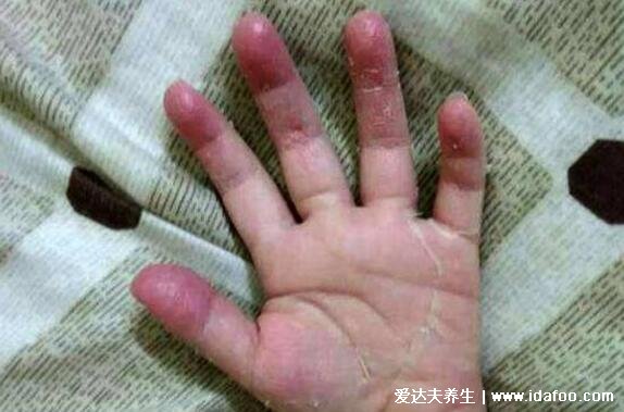 手脱皮是什么原因导致的，缺乏维生素/手癣/汗疱疹/干燥性皮炎 内链