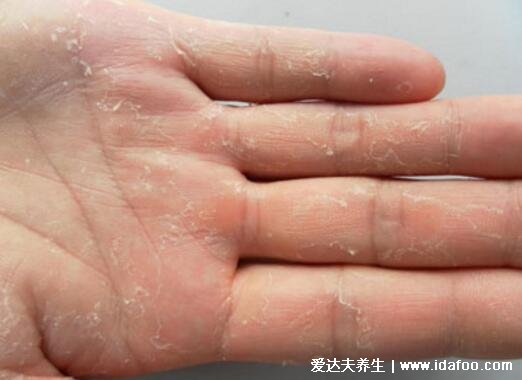 手脱皮是什么原因导致的，缺乏维生素/手癣/汗疱疹/干燥性皮炎 内链