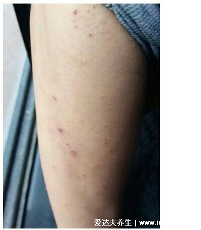 湿疹图片初期症状图片，包括女性腿上和面部(熬夜失眠也是诱因)