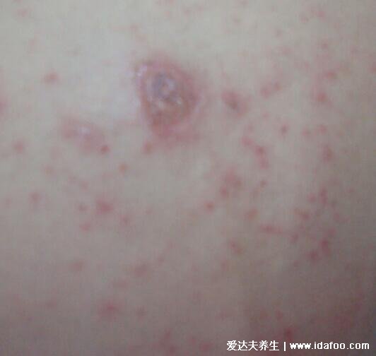 湿疹图片初期症状图片，包括女性腿上和面部(熬夜失眠也是诱因)
