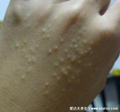 水泡和疱疹的区别图片，疱疹会有身体症状(带状疱疹神经痛)