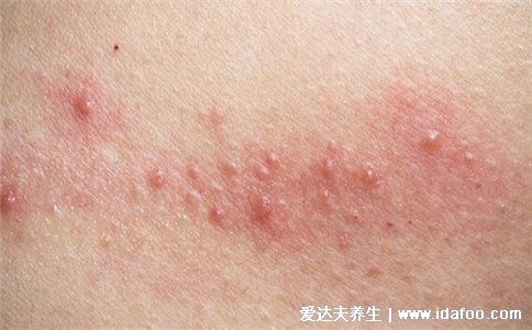 水泡和疱疹的区别图片，疱疹会有身体症状(带状疱疹神经痛)