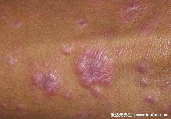 梅毒的早期症状图片，硬下疳圆形溃疡腹股沟有异(发热后起疹子)