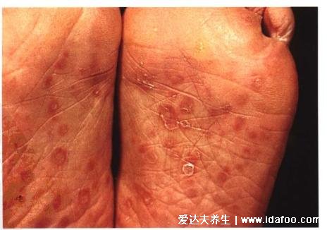 梅毒的早期症状图片，硬下疳圆形溃疡腹股沟有异(发热后起疹子)