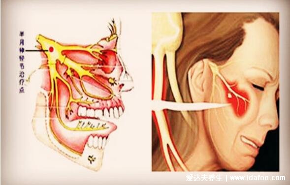 三叉神经痛是哪个部位图解，面部口腔下颌中某一点的剧烈抽痛