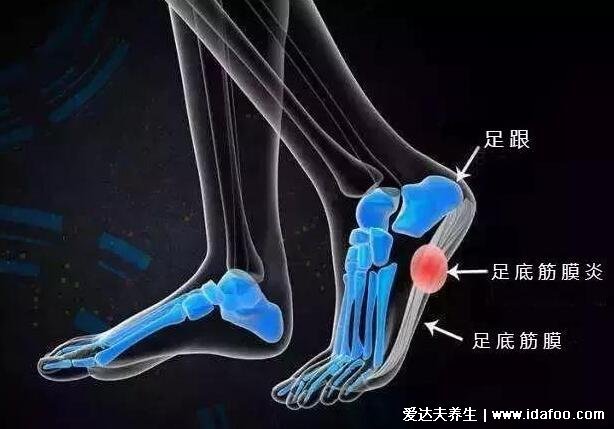 后脚跟痛是大病前兆，脚底疼痛部位图解(4种原因)