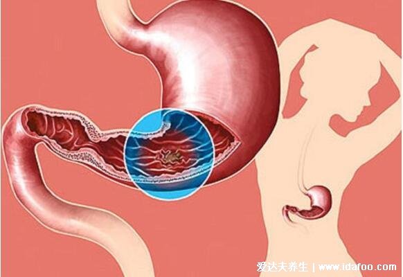 胃癌早期有三处痛，上腹部有隐隐的胀痛感(附胃癌早期舌头图片)