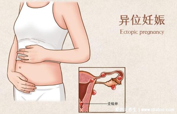 宫外怀孕有哪些前兆表现，有出血剧烈腹痛的时候要警惕