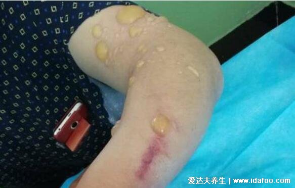 皮肤炭疽病的症状图片，红斑发展成水疱坏死形成溃疡黑痂