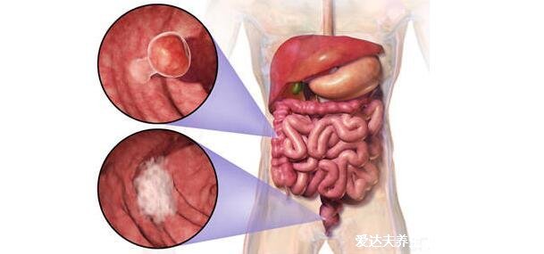 肠癌拉出来大便的图片，警惕4个最为明显的肠癌信号