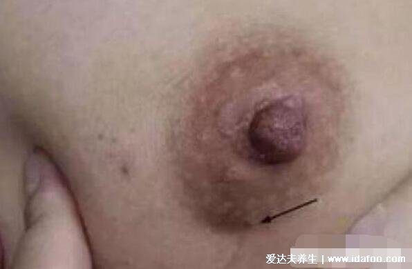乳腺癌图片大全早期症状真人，乳房有肿块皮肤凹陷时要及时诊治