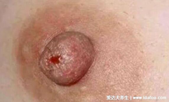 乳腺癌图片大全早期症状真人，乳房有肿块皮肤凹陷时要及时诊治