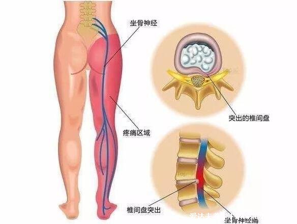 坐骨神经痛的疼点图，教你寻找痛点并消除疼痛(单侧腰部到脚外侧)