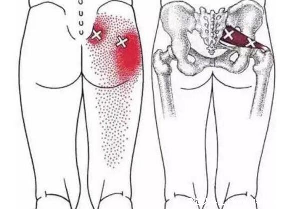 坐骨神经痛的疼点图，教你寻找痛点并消除疼痛(单侧腰部到脚外侧)