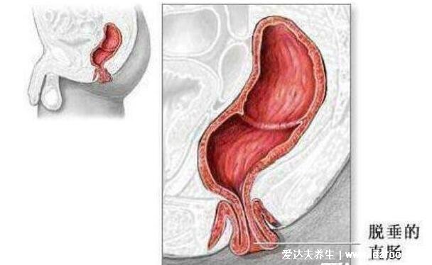 肛门口有个肉球突出是怎么回事，痔疮/肠息肉/皮疹/过敏(图片)