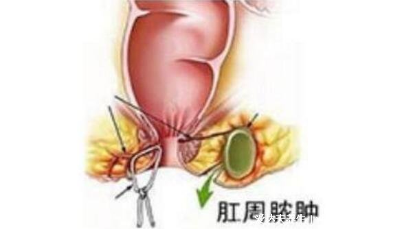 肛门口有个肉球突出是怎么回事，痔疮/肠息肉/皮疹/过敏(图片)