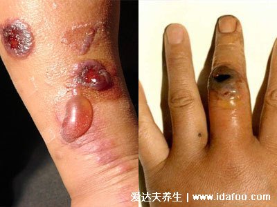 人体感染炭疽病图片人图片是什么病，皮肤炭疽多见(炭疽4种类型)