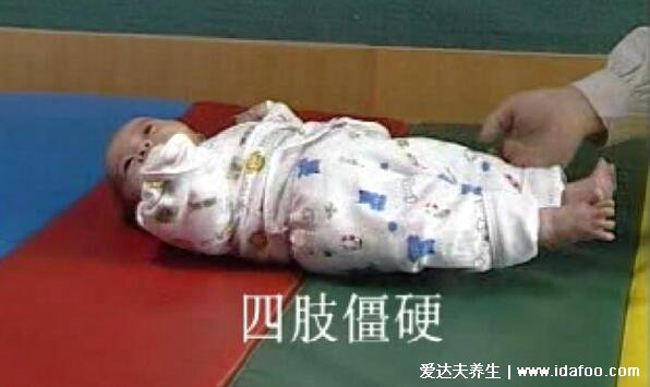 7种方式判断是不是脑瘫，四肢僵硬姿势异常的宝宝要注意了