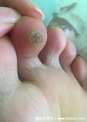 寻常疣初期症状图片，刚开始有丘疹后变粗糙很硬(手脚常见)