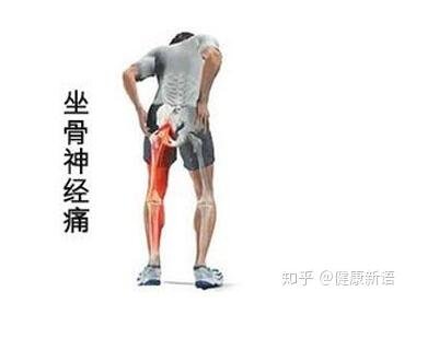 坐骨神经痛的疼点图，多是腰突导致且臀腿一侧疼(附正确睡姿图)