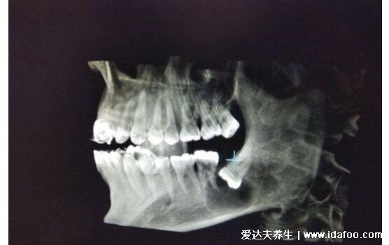拔智齿几天才能恢复正常，3个月完全愈合(附智齿拔牙后窟窿恢复图)