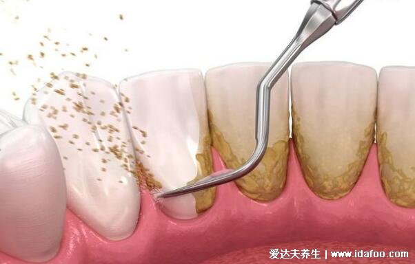 牙齿发黄怎么去除变白，七个去牙黄最有效的土方法