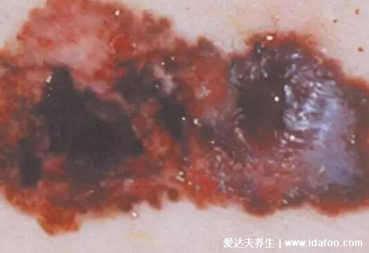 皮肤癌早期症状图片，有4种类型皮肤癌(鳞状和基底细胞癌常见)