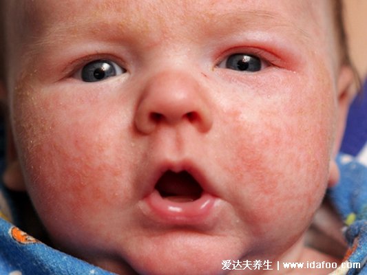 婴儿奶藓图片长什么样子，头面部有红疹还有白屑(出生2到3月要注意)