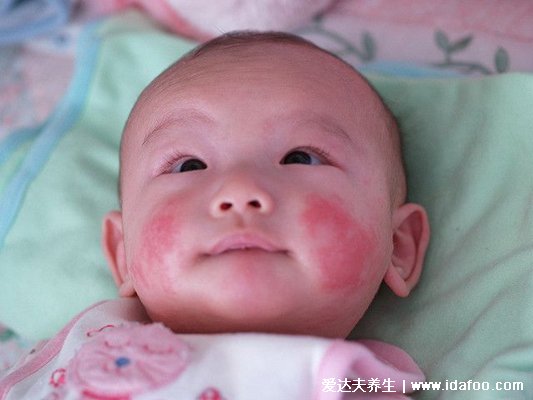 婴儿奶藓图片长什么样子，头面部有红疹还有白屑(出生2到3月要注意)