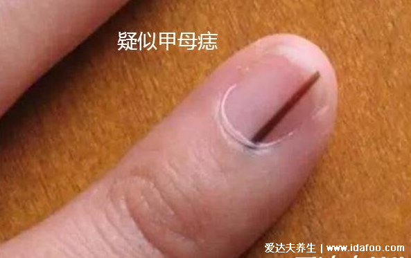 指甲竖纹当心三大疾病，警惕黑色竖纹可能是肝肾两衰