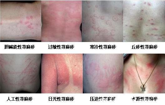 过敏和疹子的区别图片，过敏可引起湿疹/荨麻疹(各种疹子的症状图片)