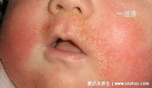 皮炎和湿疹区别图片，湿疹可发于成人头部四肢(100种皮肤病对照图片)