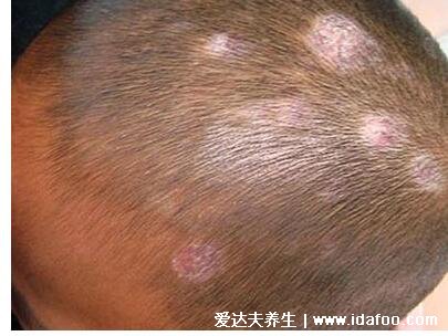 皮炎和湿疹区别图片，湿疹可发于成人头部四肢(100种皮肤病对照图片)