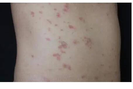 玫瑰糠疹初期症状图片，淡红斑有鳞屑可瘙痒(青年中年易得)