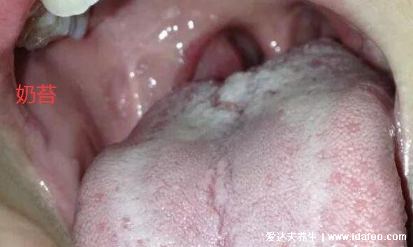 婴儿鹅口疮的图片早期症状，长在口腔的白色斑片不易刮掉(和奶苔不同)