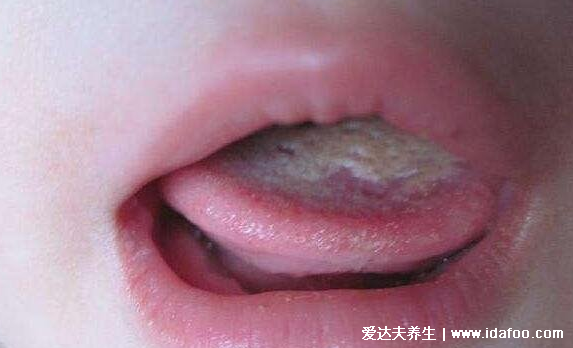 婴儿鹅口疮的图片早期症状，长在口腔的白色斑片不易刮掉(和奶苔不同)
