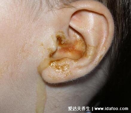 千万不要频繁掏耳朵，后果就是霉菌感染导致听力下降