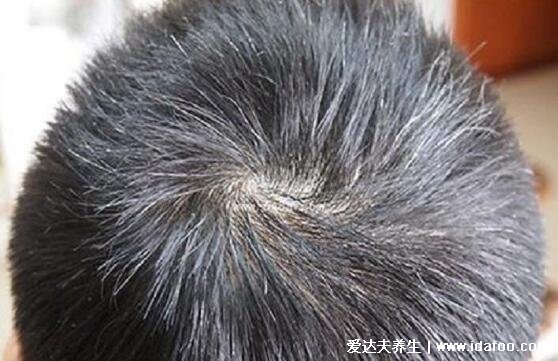 叶酸片能治白头发吗，最多只能改善缺乏叶酸导致的白发