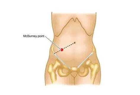阑尾在哪个位置？阑尾炎是哪个部位疼图片，注意可转移右下腹疼痛
