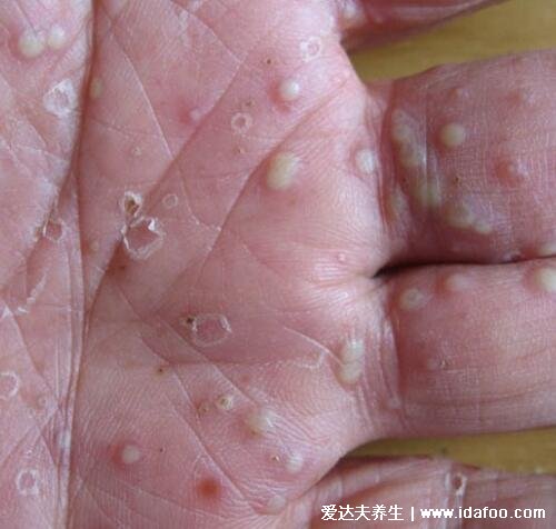 汗疱疹图片和症状图片，在手脚会出现水疱瘙痒(春夏较多要注意)
