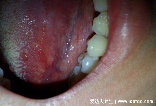 舌癌的早期症状图片，初期会有溃疡白斑容易被忽略(胆小慎入)