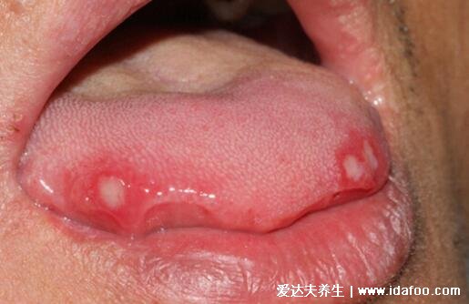 舌癌的早期症状图片，初期会有溃疡白斑容易被忽略(胆小慎入)